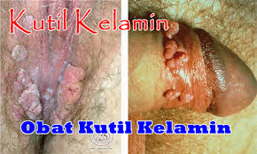 Gambar Penyakit Kelamin