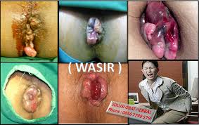 Wasir